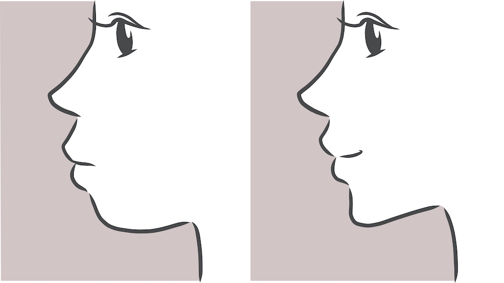 非抜歯矯正で起こる顔の変化 ─ 横顔・Eライン・口元の具体像